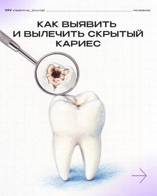Скрытый кариес: диагностика и лечение современными методами.